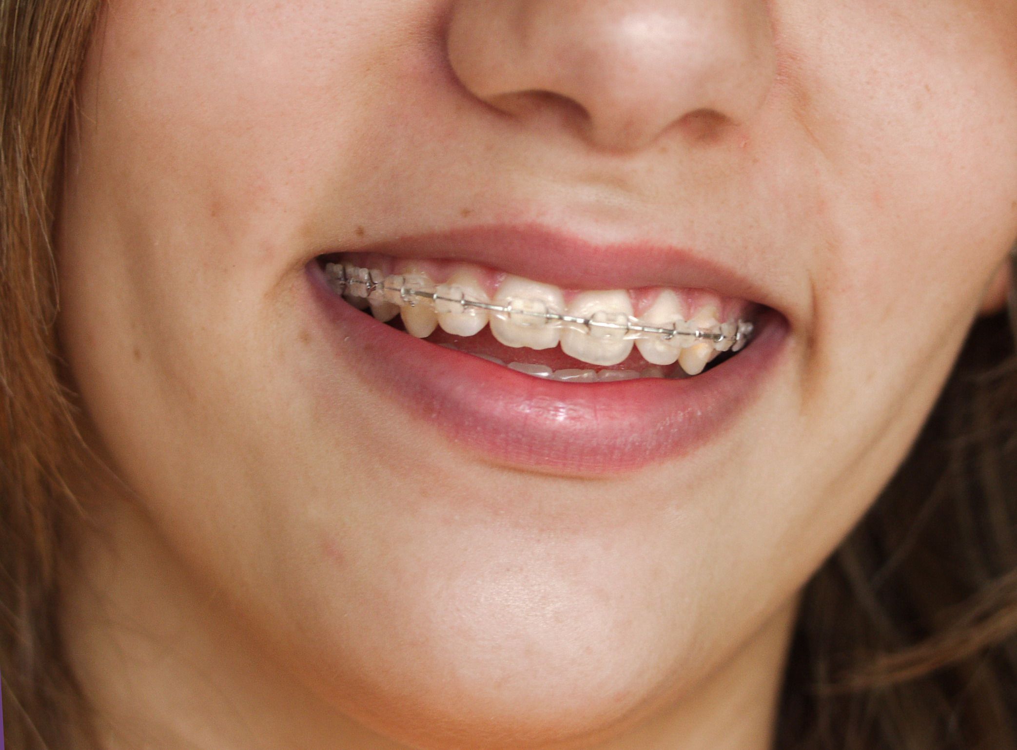 Considering Options for Adult Braces in Bethesda MD