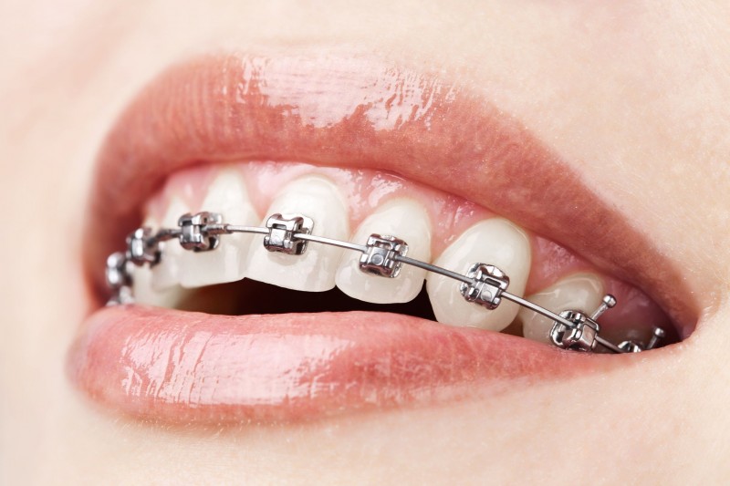 Types Of Braces In Downers Grove And How They Work