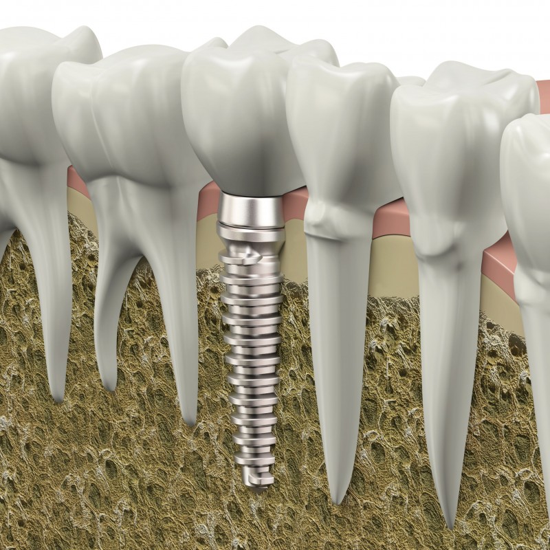 Where To Get Dental Implants And Dentures In Panama City FL