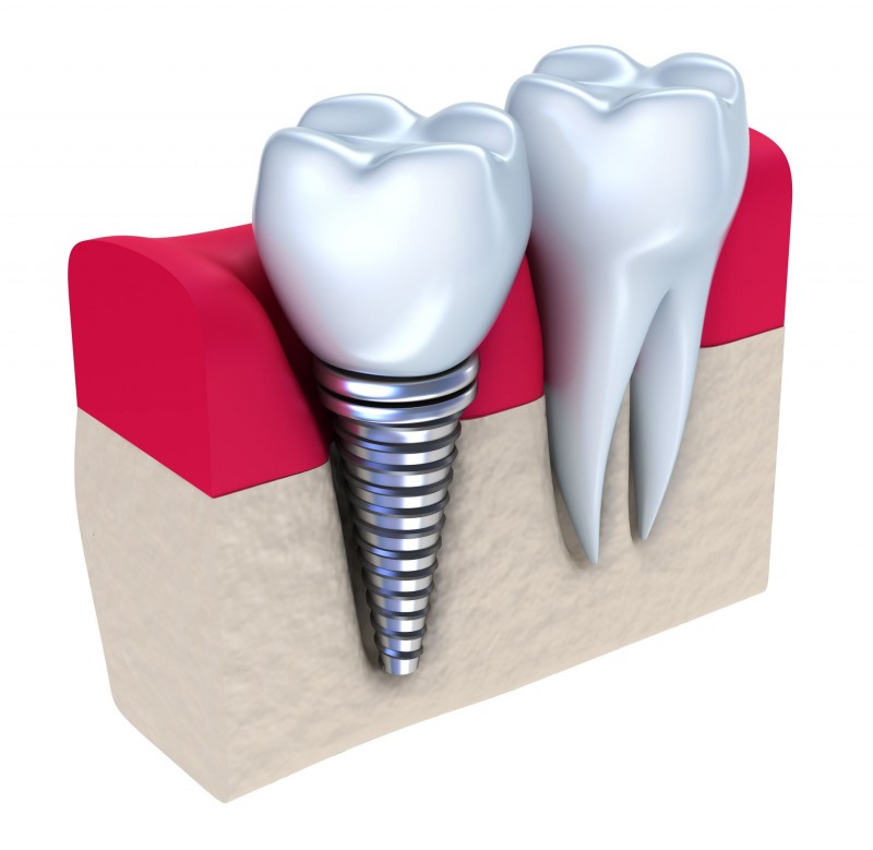 A Restorative Dentist Uses Dental Implants to Replace Missing Teeth