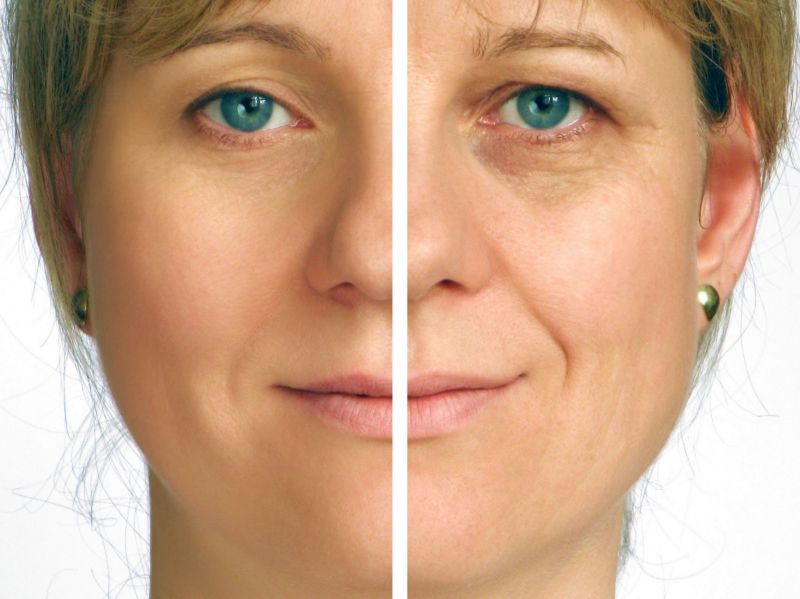 Top Non-Surgical Facelifts to Consider Trying