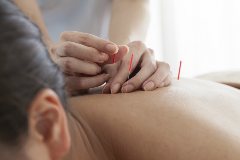 Benefits of Acupuncture Treatment in Rumson