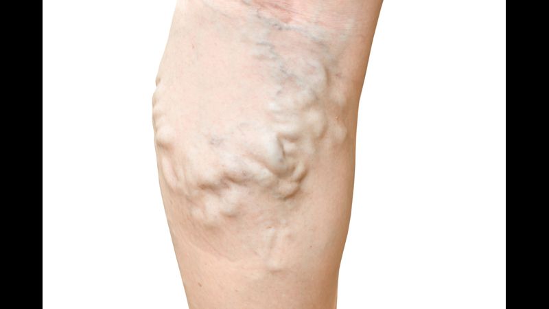 Benefits of Varicose Vein Treatment in Bensalem, PA