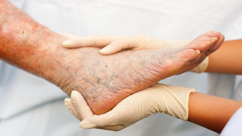 Having Venous Leg Ulcers in Colorado Springs Doesn’t Have to Be Permanent